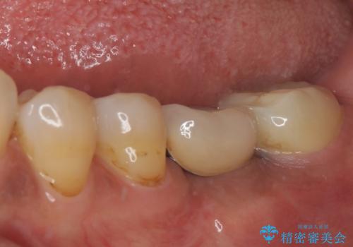 しみる奥歯 オールセラミッククラウンによる補綴治療の治療後