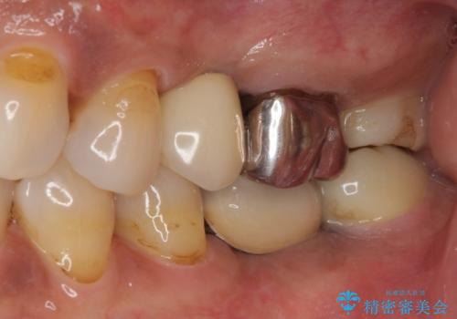 しみる奥歯 オールセラミッククラウンによる補綴治療の治療後