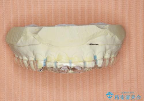 ナイトガードで歯ぎしり予防の治療中