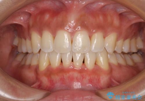 抜歯矯正で唇を閉じやすく 目立たないワイヤー装置の症例 治療後