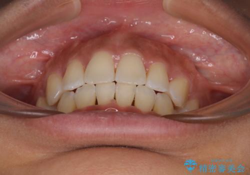 抜歯矯正で唇を閉じやすく 目立たないワイヤー装置の治療後