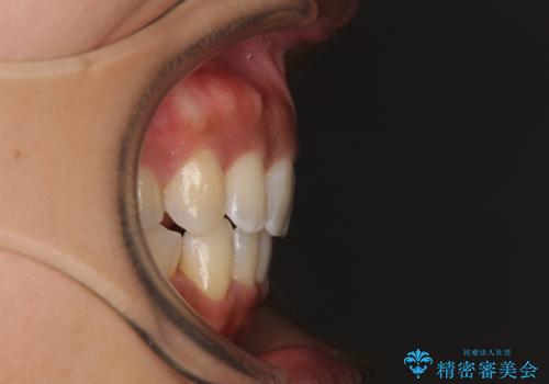 抜歯矯正で唇を閉じやすく 目立たないワイヤー装置の治療後