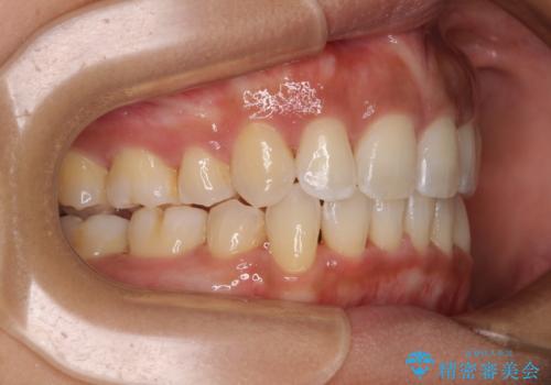抜歯矯正で唇を閉じやすく 目立たないワイヤー装置の治療後
