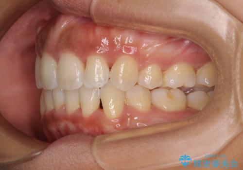 抜歯矯正で唇を閉じやすく 目立たないワイヤー装置の治療後