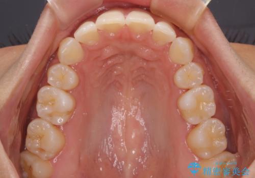 抜歯矯正で唇を閉じやすく 目立たないワイヤー装置の治療後
