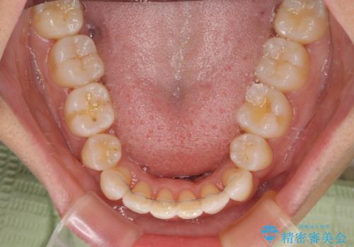 抜歯矯正で唇を閉じやすく　目立たないワイヤー装置の治療後