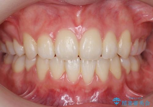 八重歯　歯並びのがたつきの症例 治療後