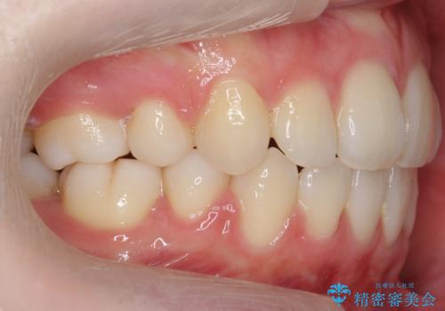 八重歯 歯並びのがたつきの治療後