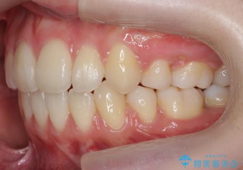 八重歯 歯並びのがたつきの治療後