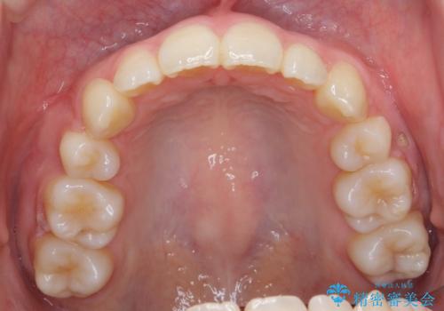 八重歯 歯並びのがたつきの治療後