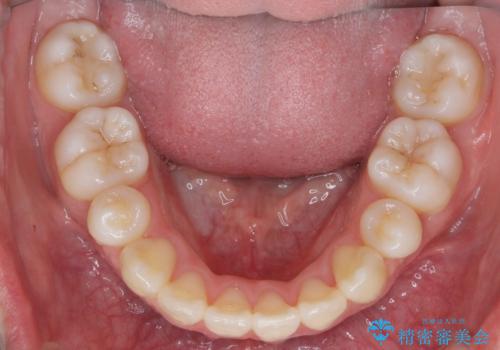 八重歯　歯並びのがたつきの治療後