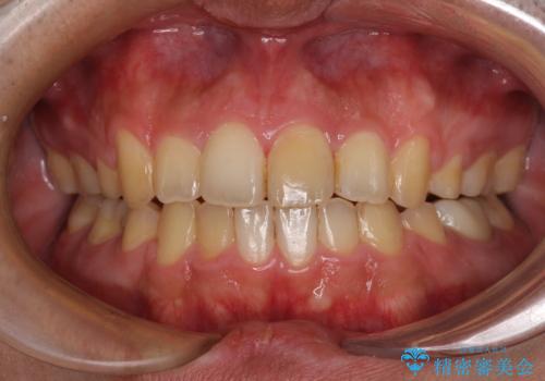 後戻りでデコボコの前歯 インビザライン矯正治療の治療後