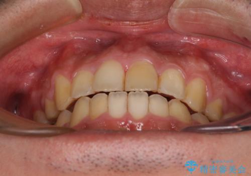 後戻りでデコボコの前歯 インビザライン矯正治療の治療後