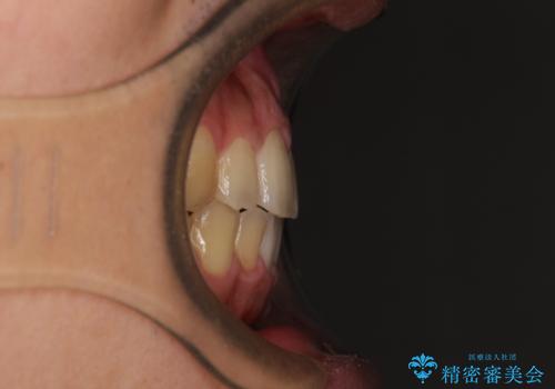 後戻りでデコボコの前歯 インビザライン矯正治療の治療後