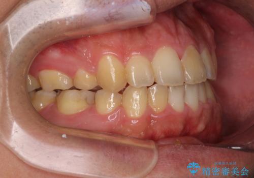 後戻りでデコボコの前歯 インビザライン矯正治療の治療後
