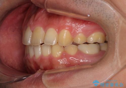 後戻りでデコボコの前歯 インビザライン矯正治療の治療後