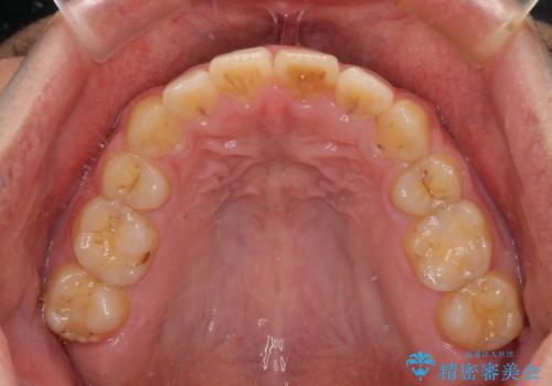 後戻りでデコボコの前歯 インビザライン矯正治療の治療後