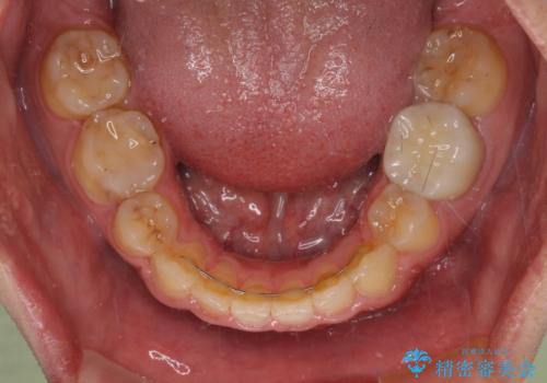 後戻りでデコボコの前歯 インビザライン矯正治療の治療後