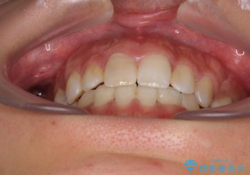 気になる八重歯 目立ちにくいハーフリンガルでの抜歯矯正の治療後