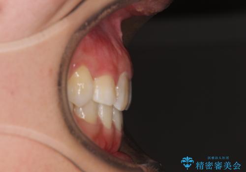 気になる八重歯 目立ちにくいハーフリンガルでの抜歯矯正の治療後
