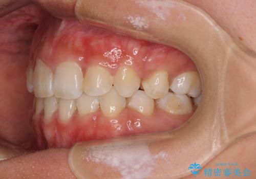 気になる八重歯 目立ちにくいハーフリンガルでの抜歯矯正の治療後