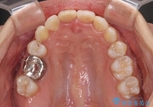気になる八重歯 目立ちにくいハーフリンガルでの抜歯矯正の治療後