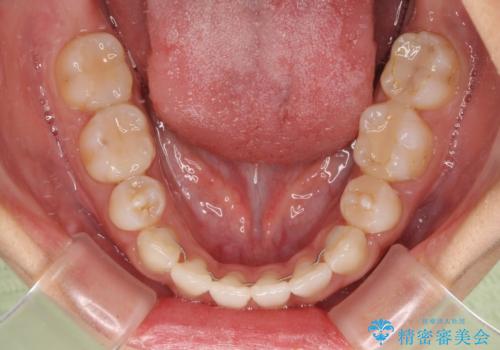 気になる八重歯 目立ちにくいハーフリンガルでの抜歯矯正の治療後