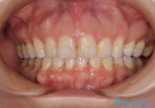 出っ歯と咬み合わせを改善　ワイヤー装置の抜歯矯正の症例 治療後