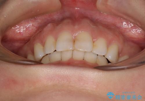 出っ歯と咬み合わせを改善 ワイヤー装置の抜歯矯正の治療後