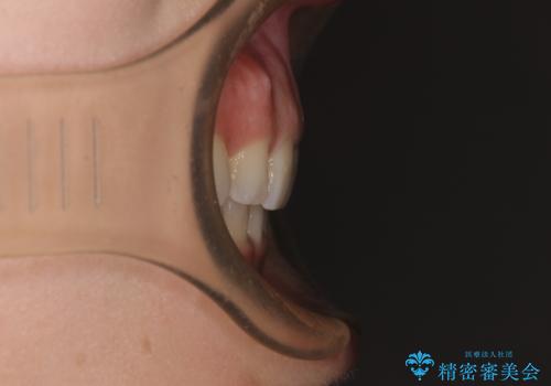 出っ歯と咬み合わせを改善　ワイヤー装置の抜歯矯正の治療後
