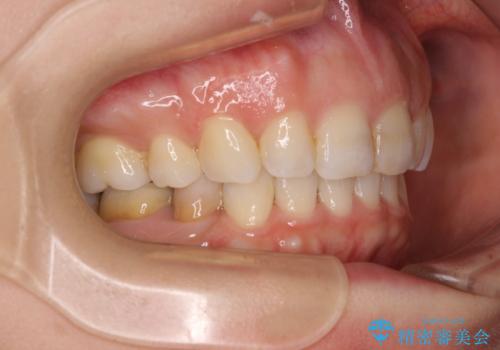 出っ歯と咬み合わせを改善 ワイヤー装置の抜歯矯正の治療後