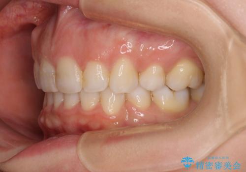 出っ歯と咬み合わせを改善 ワイヤー装置の抜歯矯正の治療後