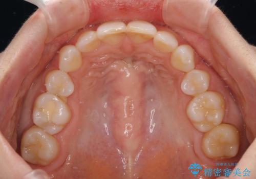 出っ歯と咬み合わせを改善　ワイヤー装置の抜歯矯正の治療後
