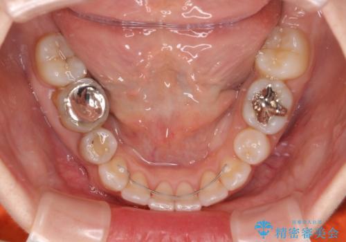 出っ歯と咬み合わせを改善 ワイヤー装置の抜歯矯正の治療後