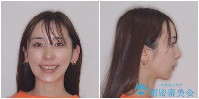 出っ歯と咬み合わせを改善　ワイヤー装置の抜歯矯正の治療後（顔貌）