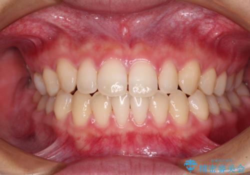 隙間だらけの歯列 インビザラインで改善の治療中