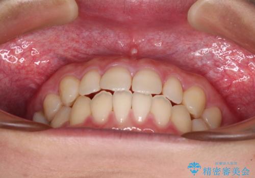隙間だらけの歯列 インビザラインで改善の治療中