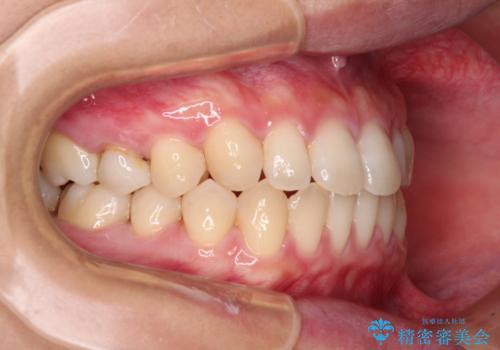 隙間だらけの歯列 インビザラインで改善の治療中