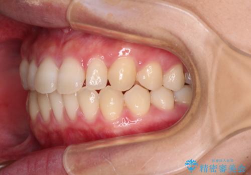 隙間だらけの歯列 インビザラインで改善の治療中