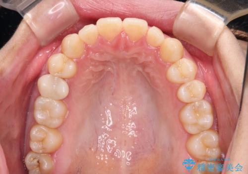 隙間だらけの歯列 インビザラインで改善の治療中
