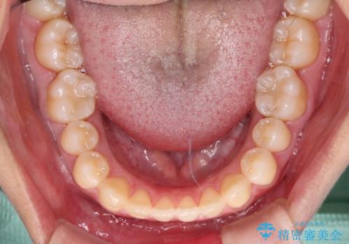 隙間だらけの歯列 インビザラインで改善の治療中