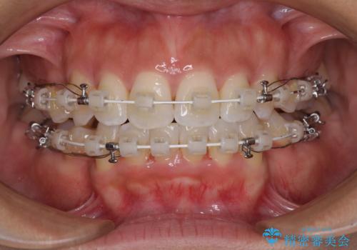 抜歯矯正で唇を閉じやすく 目立たないワイヤー装置の治療中