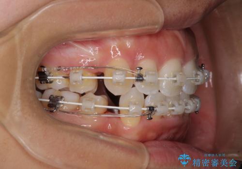 抜歯矯正で唇を閉じやすく 目立たないワイヤー装置の治療中