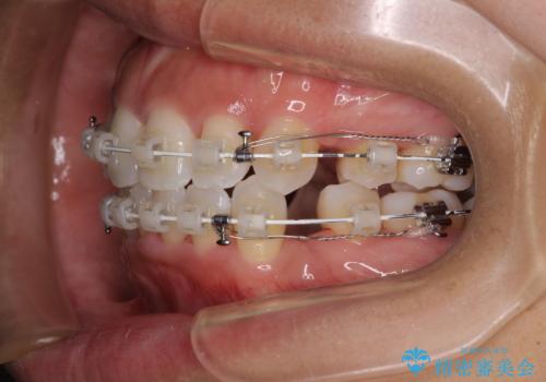 抜歯矯正で唇を閉じやすく 目立たないワイヤー装置の治療中