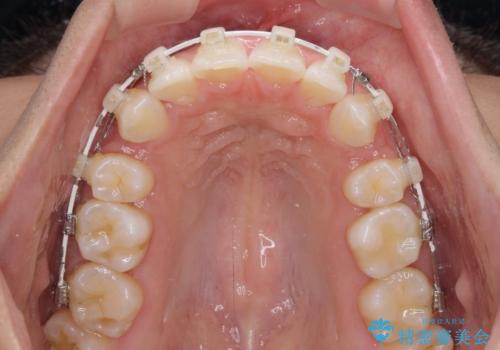 抜歯矯正で唇を閉じやすく 目立たないワイヤー装置の治療中
