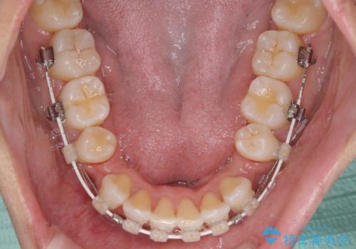抜歯矯正で唇を閉じやすく　目立たないワイヤー装置の治療中