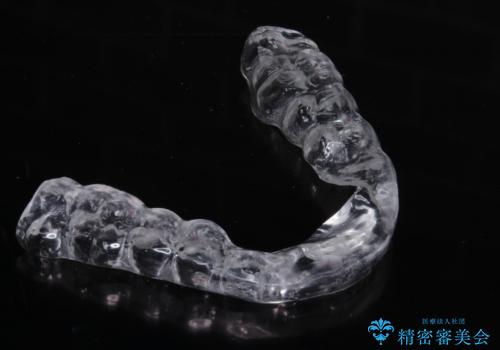 歯ぎしりが気になる。の治療中