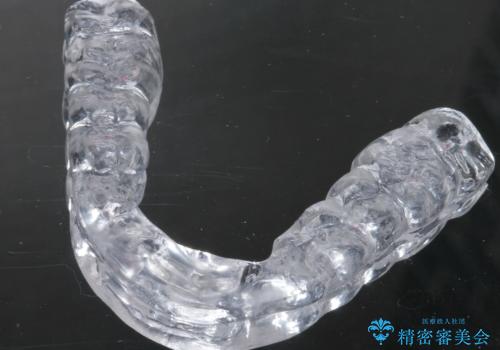 歯ぎしりが気になる。の治療後