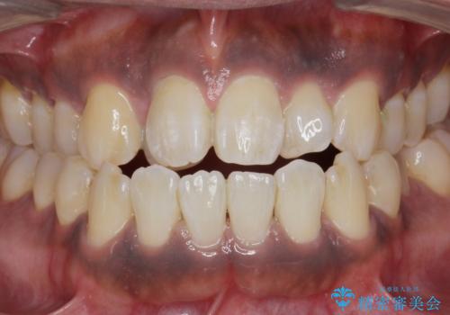 歯ぎしりが気になる。の治療前