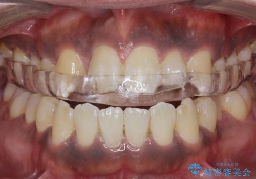 歯ぎしりが気になる。の治療後